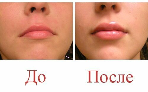 Увеличение губ гиалуроновой кислотой: до и после, фото
