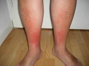 Заболевание рожа на ноге симптомы