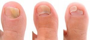 Микозан от грибка ногтей: отзывы, цена