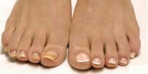 Грибок ногтей на ногах: чем лечить?